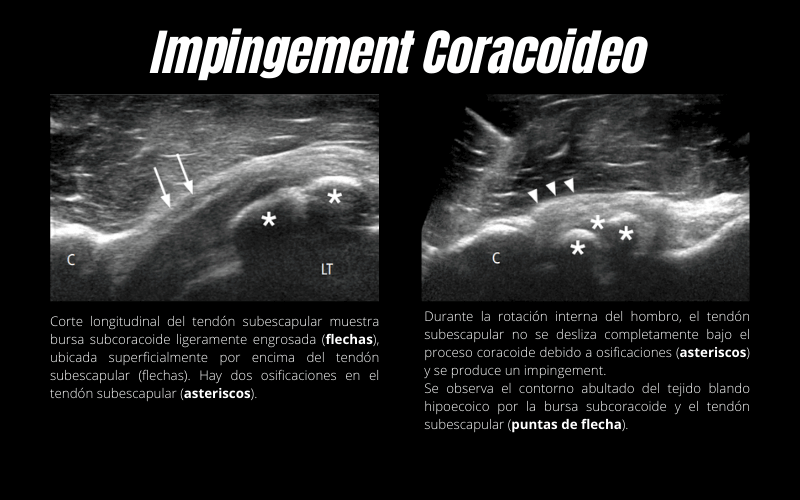 Impingement Coracoideo Ecografía.png